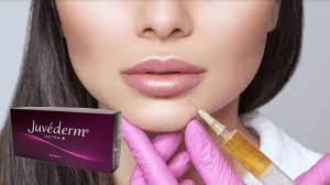 Juvederm Ultra 3 Hyaluronic Acid HA Dermal Filler 2ml ঠোঁট বাড়ানো